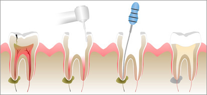 Ordinacija_Sailovic_endodoncija_2