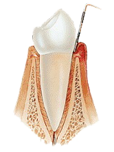 Ordinacija_Sailovic_gingivitis